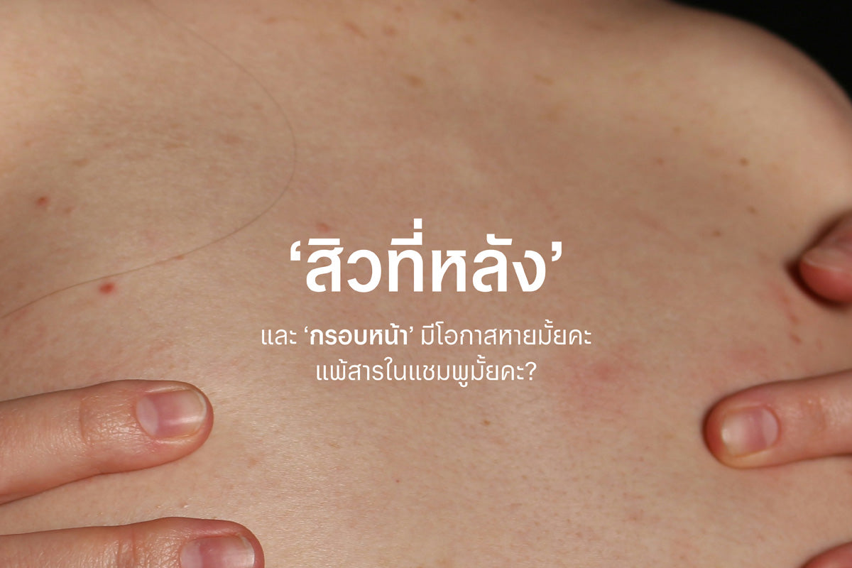 สิวที่หลัง กรอบหน้า ไม่หายสักทีหรือเราแพ้สารในแชมพูมั้ยคะ?